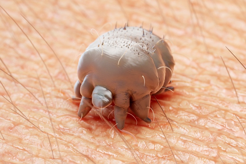 scabies